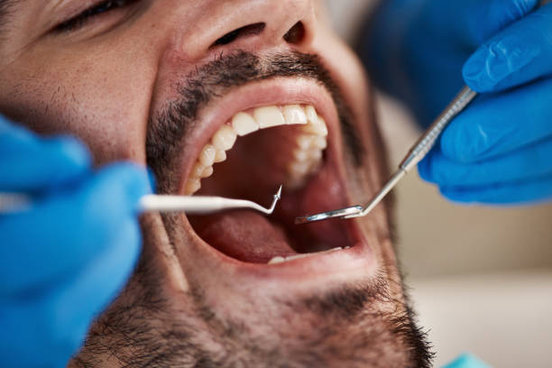 Best Emergency Dental Care for Broken or Chipped Teeth in Fayetteville, PA