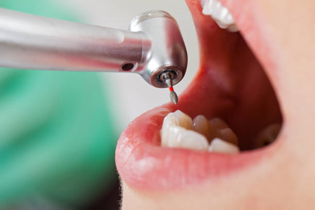 Best Urgent Care for Lost Fillings or Crowns in Fayetteville, PA